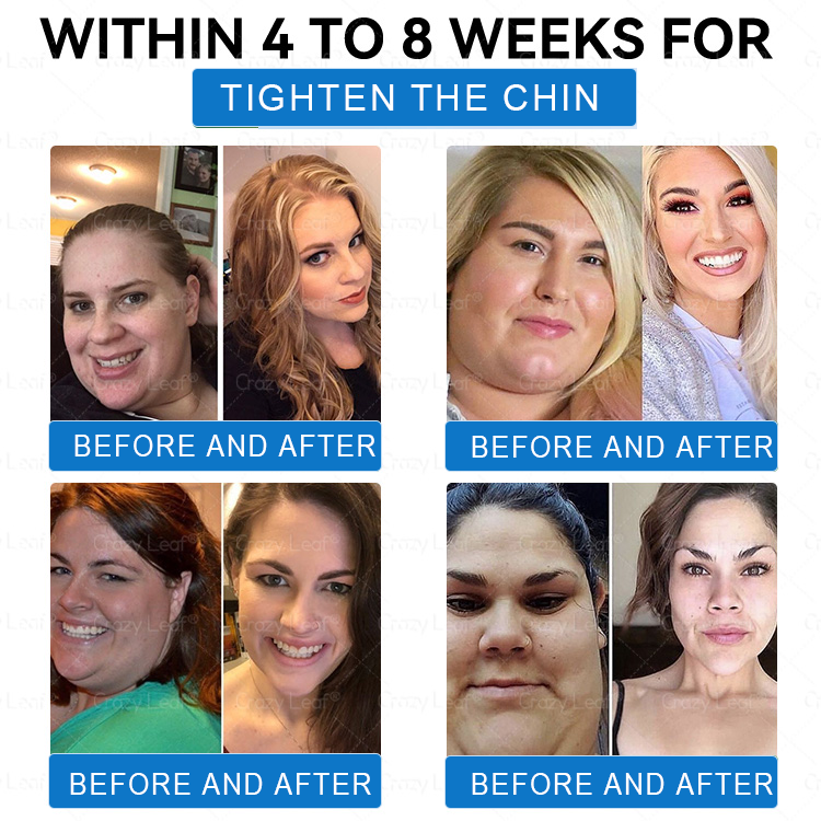 𝑪𝒓𝒂𝒛𝒚𝑳𝒆𝒂𝒇® 𝑺𝒌𝒊𝒏 𝑭𝒊𝒓𝒎𝒊𝒏𝒈 𝑷𝒂𝒕𝒄𝒉, 𝒆𝒇𝒇𝒆𝒄𝒕𝒊𝒗𝒆𝒍𝒚 𝒂𝒅𝒅𝒓𝒆𝒔𝒔𝒊𝒏𝒈 𝒔𝒌𝒊𝒏 𝒔𝒂𝒈𝒈𝒊𝒏𝒈 𝒂𝒇𝒕𝒆𝒓 𝒓𝒂𝒑𝒊𝒅 𝒘𝒆𝒊𝒈𝒉𝒕 𝒍𝒐𝒔𝒔. 𝑶𝒓𝒅𝒆𝒓 𝒏𝒐𝒘 𝒂𝒏𝒅 𝒆𝒏𝒋𝒐𝒚 𝒂 50% 𝒅𝒊𝒔𝒄𝒐𝒖𝒏𝒕!