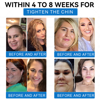 𝑪𝒓𝒂𝒛𝒚𝑳𝒆𝒂𝒇® 𝑺𝒌𝒊𝒏 𝑭𝒊𝒓𝒎𝒊𝒏𝒈 𝑷𝒂𝒕𝒄𝒉, 𝒆𝒇𝒇𝒆𝒄𝒕𝒊𝒗𝒆𝒍𝒚 𝒂𝒅𝒅𝒓𝒆𝒔𝒔𝒊𝒏𝒈 𝒔𝒌𝒊𝒏 𝒔𝒂𝒈𝒈𝒊𝒏𝒈 𝒂𝒇𝒕𝒆𝒓 𝒓𝒂𝒑𝒊𝒅 𝒘𝒆𝒊𝒈𝒉𝒕 𝒍𝒐𝒔𝒔. 𝑶𝒓𝒅𝒆𝒓 𝒏𝒐𝒘 𝒂𝒏𝒅 𝒆𝒏𝒋𝒐𝒚 𝒂 50% 𝒅𝒊𝒔𝒄𝒐𝒖𝒏𝒕!