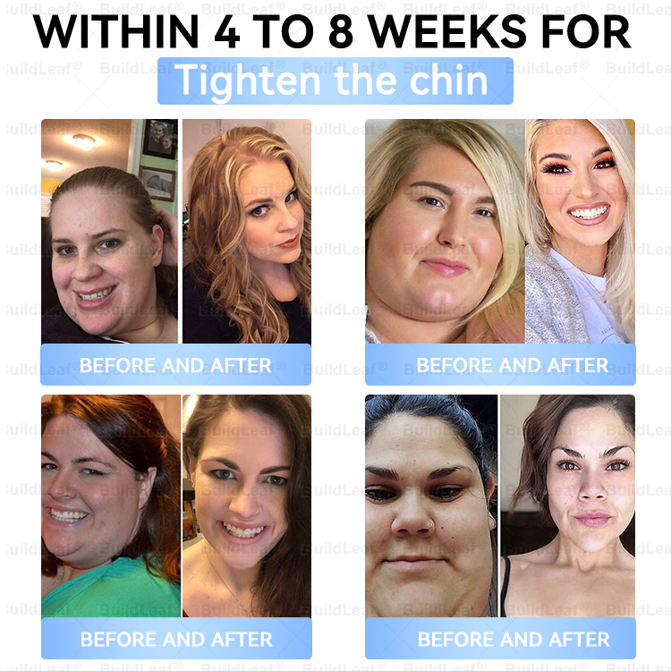 🏥FDA Store |𝐵uil𝗱𝐿ea𝐟® 𝑮𝐋𝑃-1 Slim & Firm 𝑁ano 𝑀icroneedle 𝑃atch with Collagen,Turmeric&Matrixyl 3000 丨Obesity,Cardiovascular Diseas, Diabetes, Sleep Apnea, Joint Problems and More