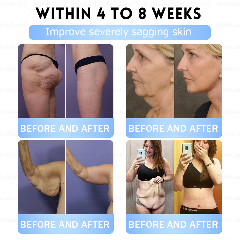 🏥FDA Store |𝐵uil𝗱𝐿ea𝐟® 𝑮𝐋𝑃-1 Slim & Firm 𝑁ano 𝑀icroneedle 𝑃atch with Collagen,Turmeric&Matrixyl 3000 丨Obesity,Cardiovascular Diseas, Diabetes, Sleep Apnea, Joint Problems and More