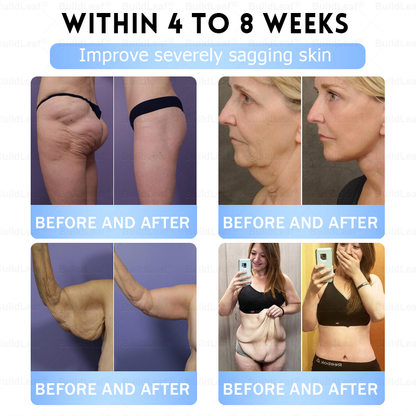 🏥FDA Store |𝐵uil𝗱𝐿ea𝐟® 𝑮𝐋𝑃-1 Slim & Firm 𝑁ano 𝑀icroneedle 𝑃atch with Collagen,Turmeric&Matrixyl 3000 丨Obesity,Cardiovascular Diseas, Diabetes, Sleep Apnea, Joint Problems and More